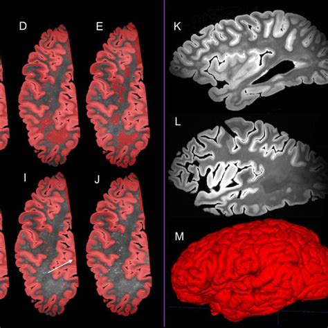 interdatabase variability in cortical thickness measurements|Normative cerebral cortical thickness for human visual areas.